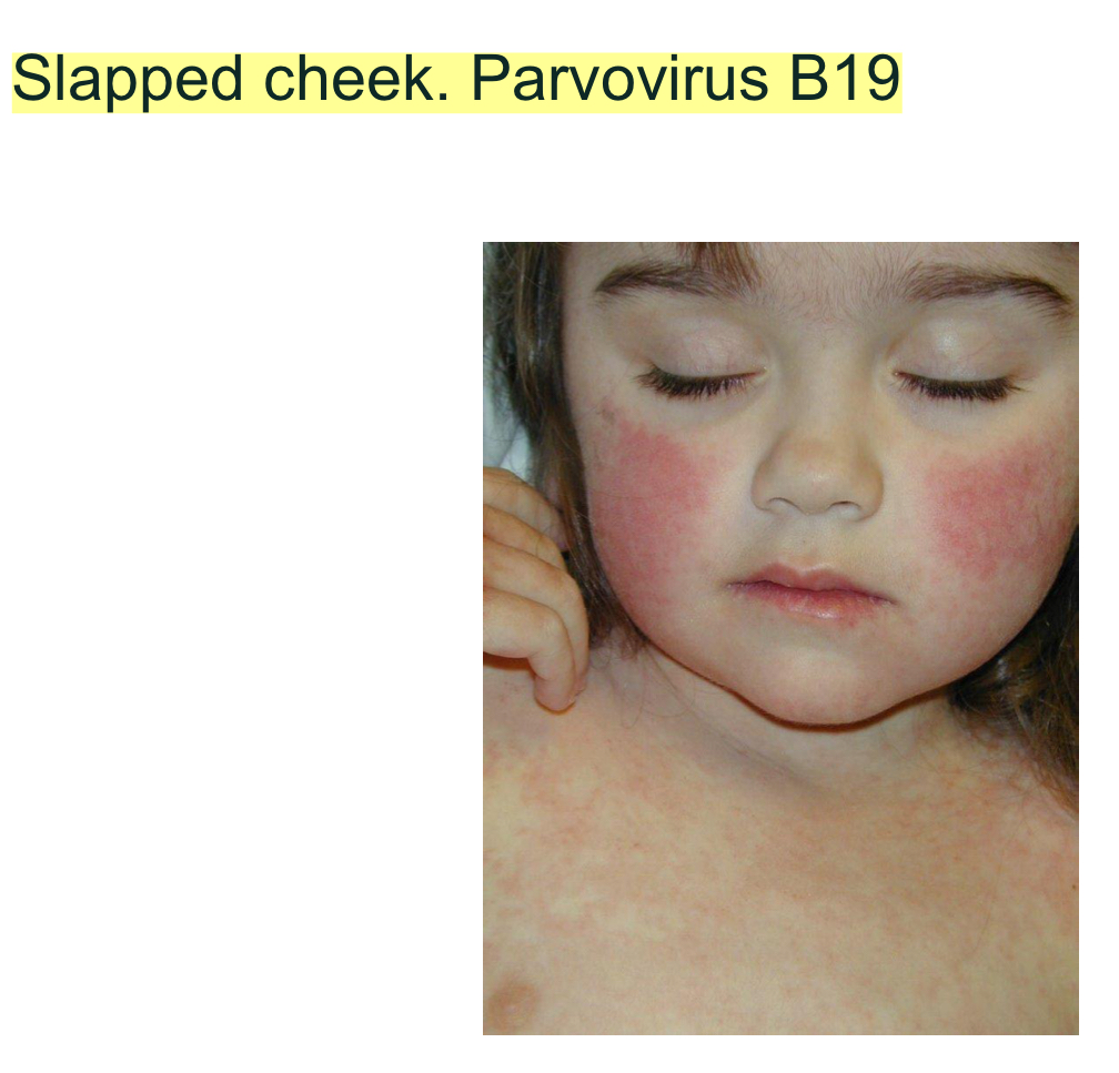 <p><strong>Parvovirus B19 (Fifth disease)-Erythema infectionsum-slapped cheek</strong></p>