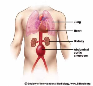 <p>Localized dilation of abdominal aorta</p>