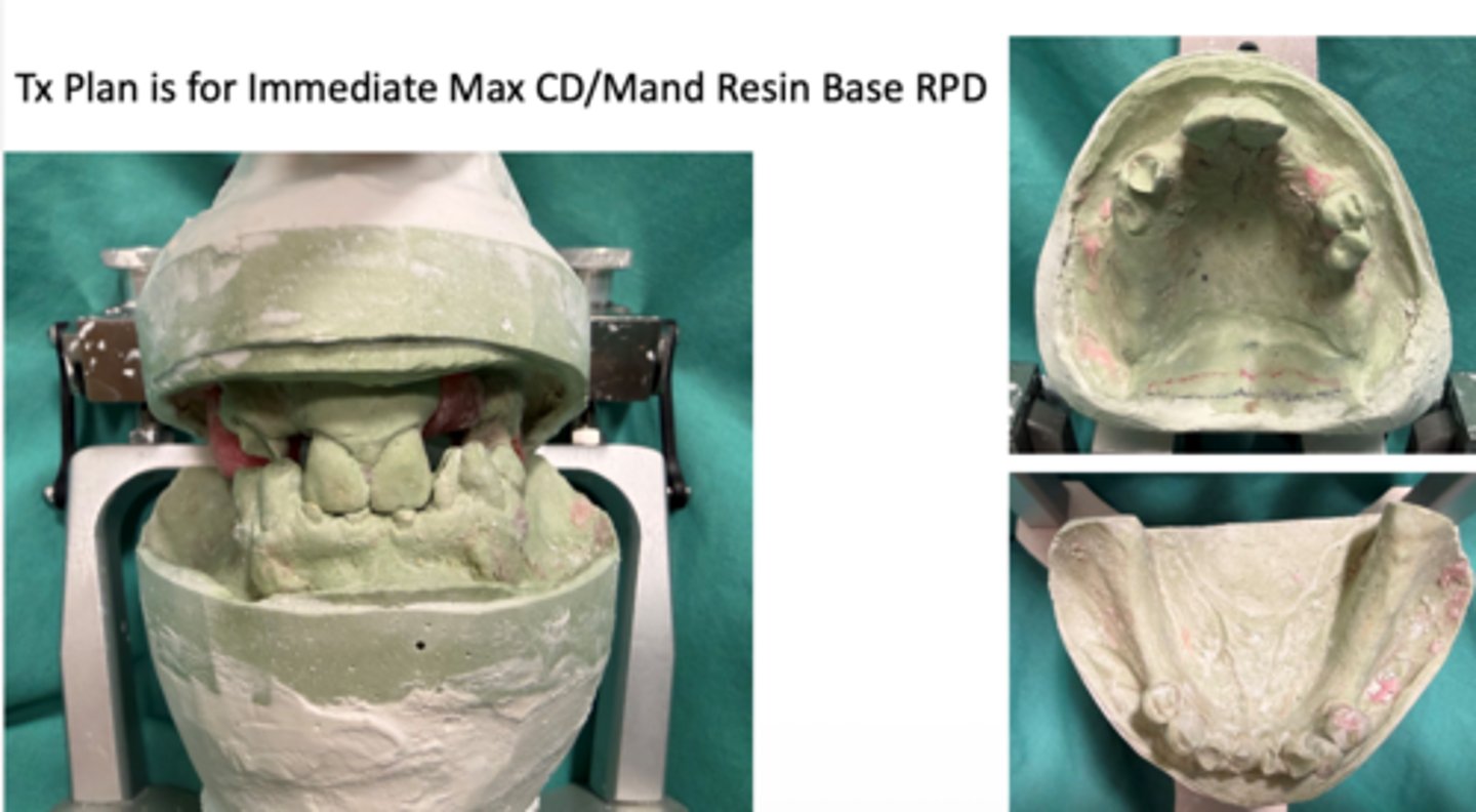 <p>Treatment plan is for Immediate Max CD/Mand Resin Base RPD. Did the student use proper type of dental stone to form this working cast for the dental prostheses?</p>