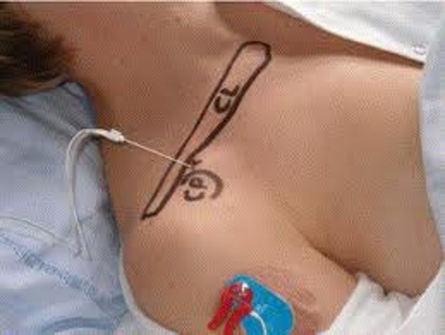 <p>a lessening of pain without loss of consciousness</p>