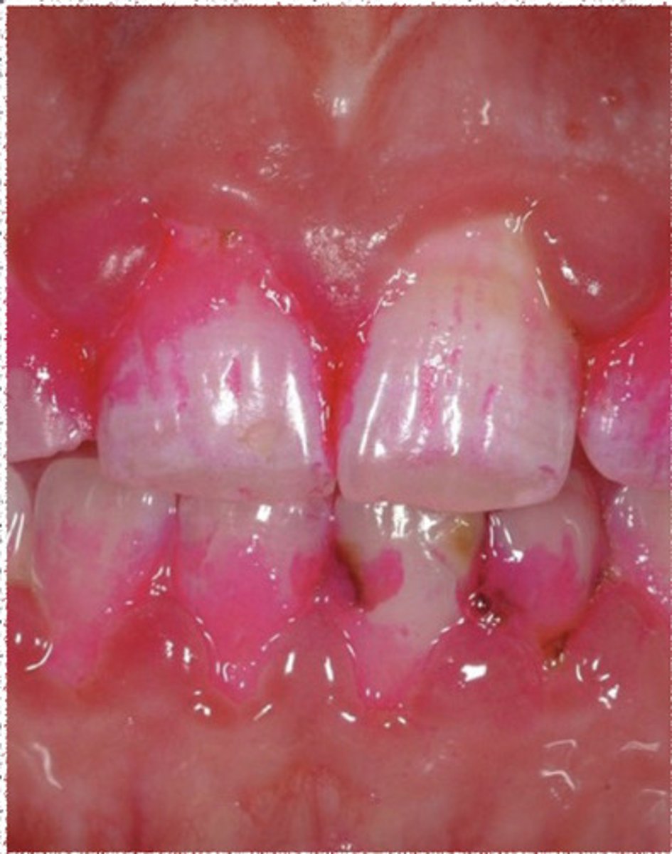 <p>-each tooth is air dried</p><p>-probe measures the level of plaque at the gingival margin</p>