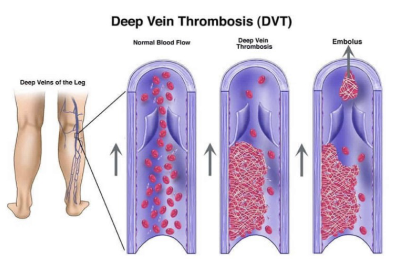 Blood clots block veins or arteries