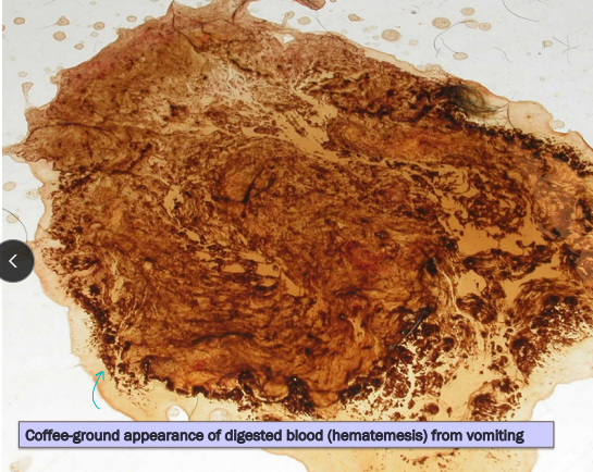 <ul><li><p><span style="background-color: transparent;"><strong><span>Et:</span></strong><span> GIT dz, renal dz, hepatic dz, pancreatitis, toxins, pain</span></span></p></li><li><p><span style="background-color: transparent;"><strong><span>Cs: </span></strong><span>abdominal contractions, salivation, </span><u><span>digested food + bile</span></u></span></p><ul><li><p><span style="background-color: transparent;"><strong><u><span>Active forceful expulsion GI and intestinal contents</span></u></strong></span></p></li></ul></li><li><p><span style="background-color: transparent;"><strong><span>Dt:</span></strong><span> metabolic alkalosis, ↓ Cl + K, Min database, endoscopy</span></span></p><ul><li><p><span style="background-color: transparent;"><span>Acute < 24h & BAR = symp Tx</span></span></p></li><li><p><span style="background-color: transparent; color: green;"><span>Chronic > 3w = workup</span></span></p></li></ul></li><li><p><span style="background-color: transparent;"><strong><span>Tx: </span></strong><span>withhold food 24h, small bland meals, oral fluids, antiemetics, </span><u><span>maropitant + ondansetron (refractory)</span></u></span></p></li></ul><p></p>