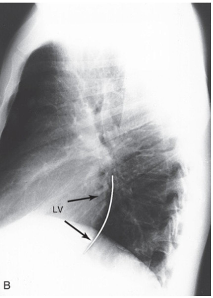 <p>- Convex left ventricle</p>