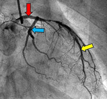 <p>A coronary arteriogram from a 53-year-old male who presented with the chief complaints of chest pain and shortness of breath reveals the accompanying image. What vessels are indicated by red, blue and yellow arrows respectively?</p><p>A. Left coronary, AV nodal, posterior interventricular</p><p>B. Left coronary, circumflex, left anterior descending</p><p>C. Left coronary, left marginal, left anterior descending</p><p>D. Left coronary, right coronary, left anterior descending</p><p>E. Right coronary, right coronary, left anterior descending</p><p>F. Right coronary, right marginal, posterior interventricular</p><p>G. Right coronary, SA nodal, posterior interventricular</p>