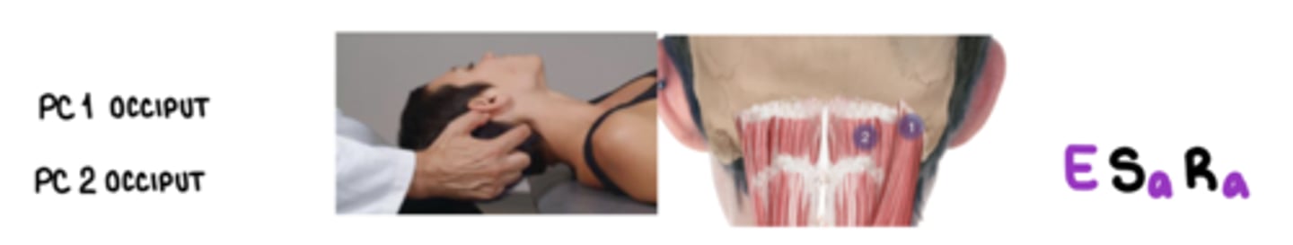 <p>E Sa Ra</p><p>inferior nuchal line w/n the semispinalis capitis m</p><p>associated with greater occipital nerve</p>