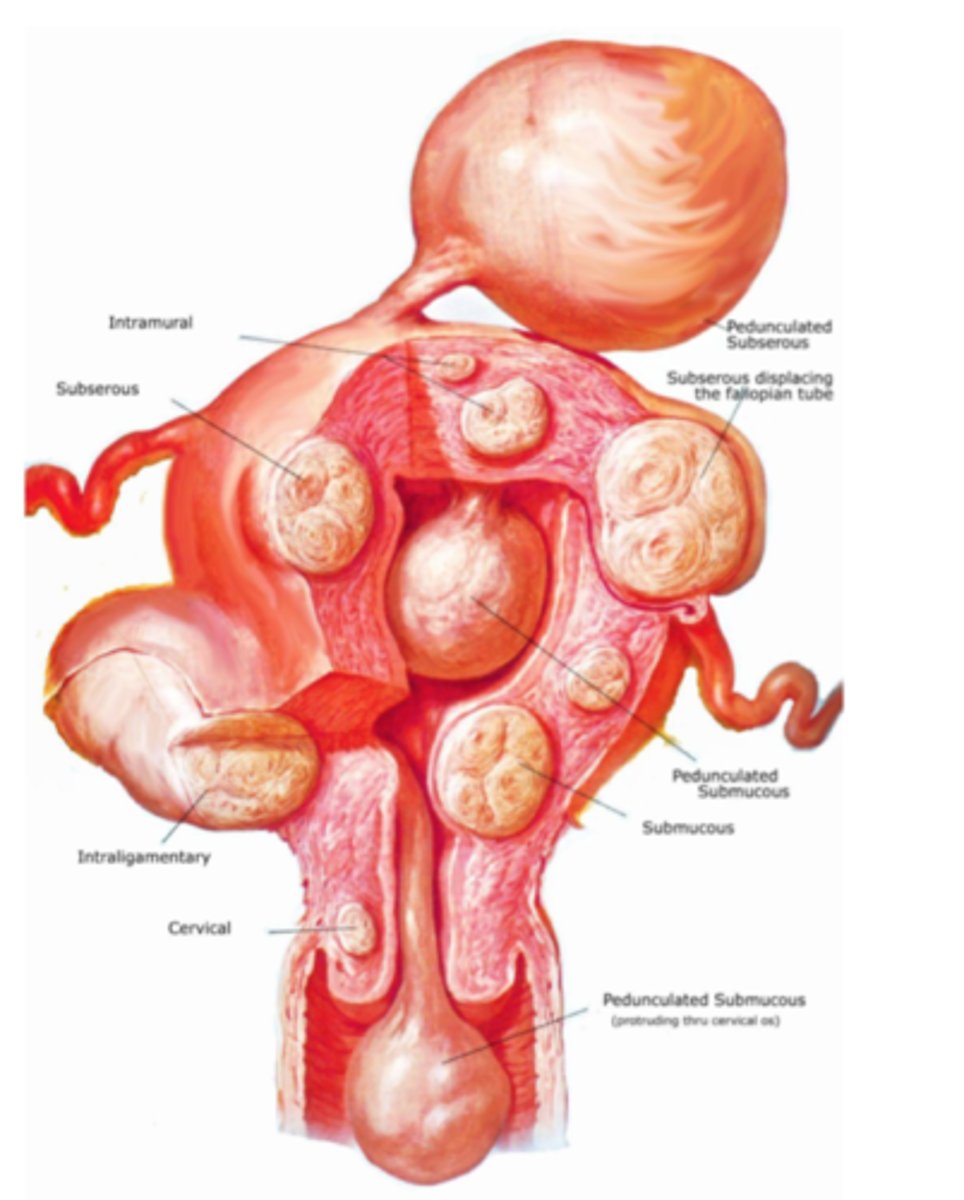 <p>benign tumors in the uterus; also called leiomyoma</p><p>can cause distention of lower abdomen</p>