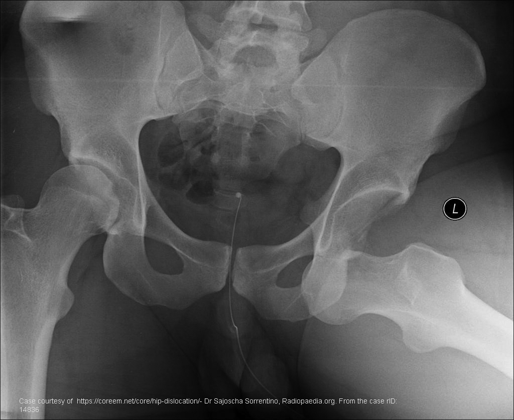 <p>Mildly flexed, abducted, externally rotated hip.</p>