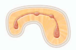 <p><span><strong><span>complete or incomplete isthmus between three or more canals</span></strong></span></p>