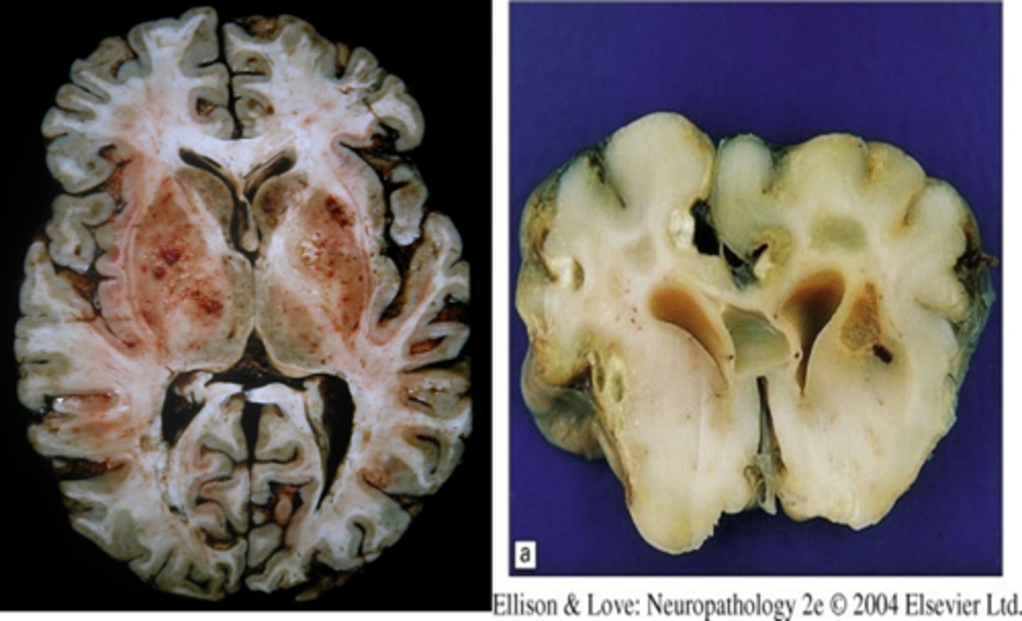 <p>Define CNS Infection Cause:</p><p>-Newborns can be exposed to parasite transplacentally (cat poop) - aka pregnant women susceptible</p><p>-Sx: headache, seizures</p><p>-Due to Tachyzoites and bradyzoites</p><p>-If immunosuppressed --&gt; forms abscess</p>