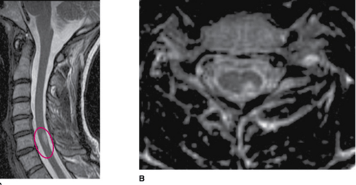 <p>What is the main abnormality visualized?</p><p>None</p><p>Artifact</p><p>Subarachnoid lesion</p><p>Intramedullary lesion</p><p>Syrinx</p>