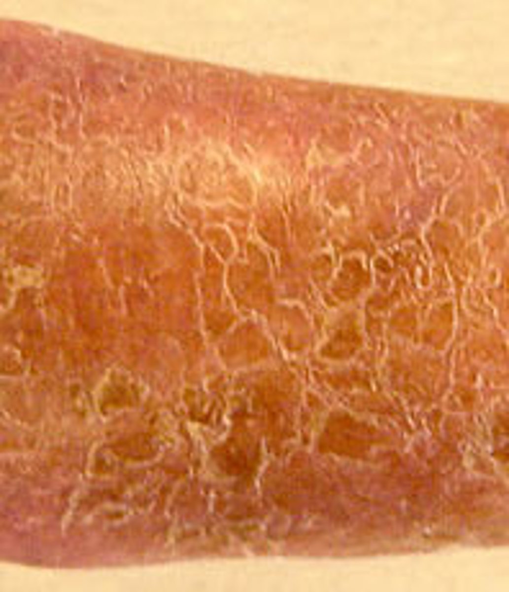 <p><b>secondary skin lesion</b><br><br>flakes of dead exfoliated epidermis - color may be white, gray or silver, texture may be fine or thick <br><br>example: Ichthyosis vulgaris, dry skin</p>