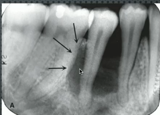 <p><strong>well defined, NON-</strong>corticated<strong> SCOOPED</strong> out appearance with epicenter at <strong>MID-ROOT in YOUNG patient </strong></p>