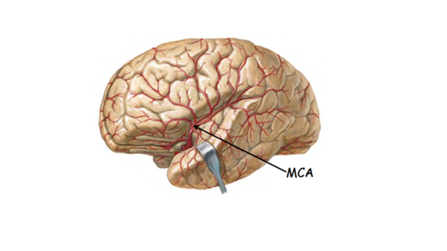 <p>enlarged, fluid filled areas and a corresponding shrinkage and thinning of cerebral tissues - larger in schizophrenic's brains</p>