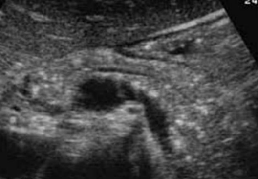 <p>Signs of <span style="color: yellow;">atrophy and calcifications</span>, very bright with hyperechoic areas, possibly smaller in size</p>