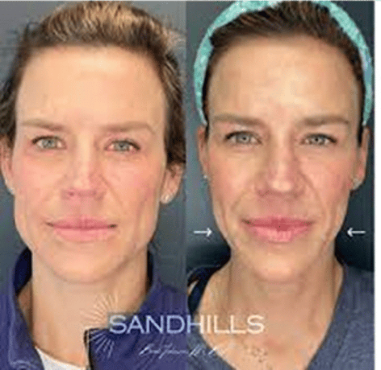 <p>What's with the masseter?</p>