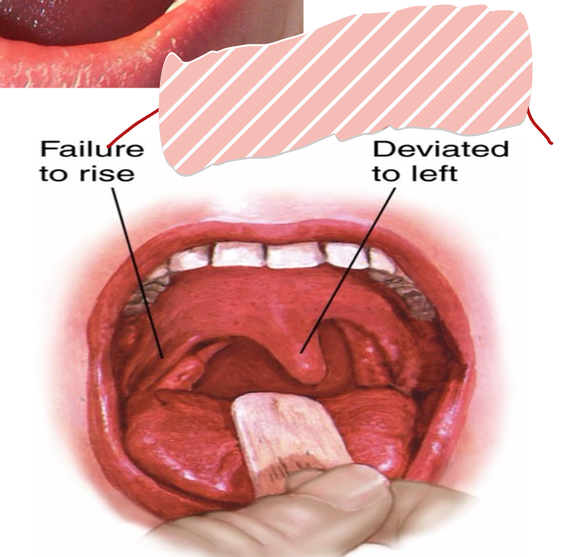 <p>Which side and CN is affected ?</p>