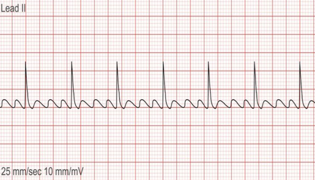 <p>Rapid succession of atrial depolarization caused by one ectopic focus in the atria that depolarizes at a rate of 250-350 times per minute</p>