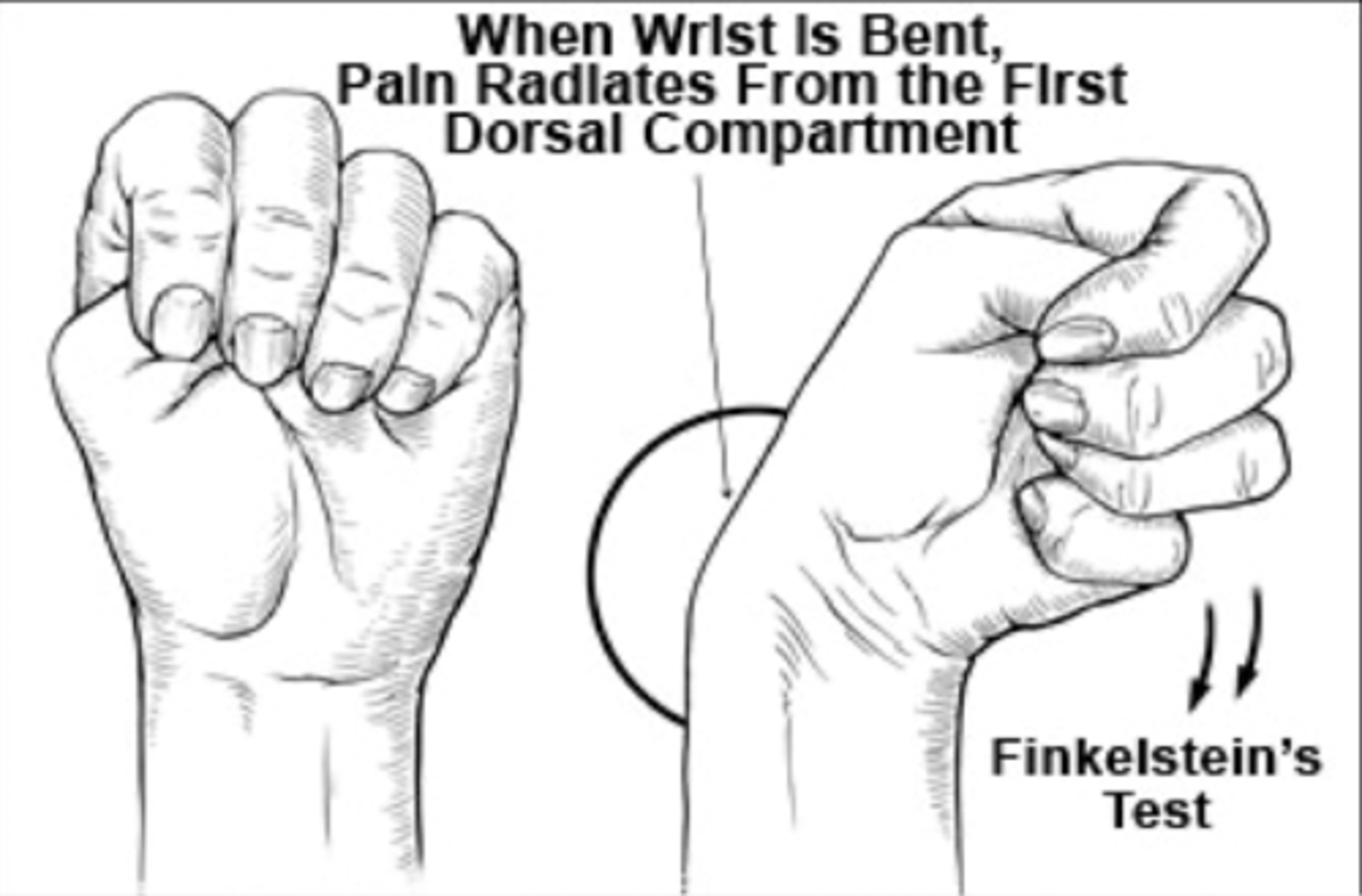 <p>1. Make fist with thumb tucked it</p><p>2. Perform ulnar deviation</p>