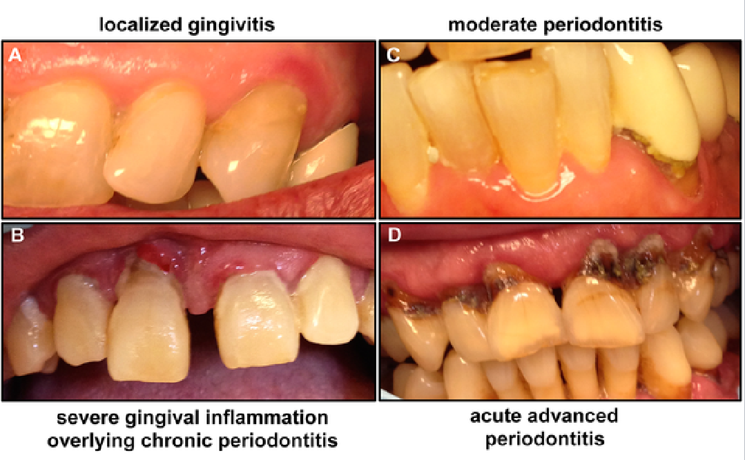 <ul><li><p>localized gingivitis</p></li><li><p>severe gingival inflammation overlying chronic periodontitis</p></li><li><p>moderate periodontitis</p></li><li><p>acute advanced periodontitis&nbsp;</p></li></ul><p></p>