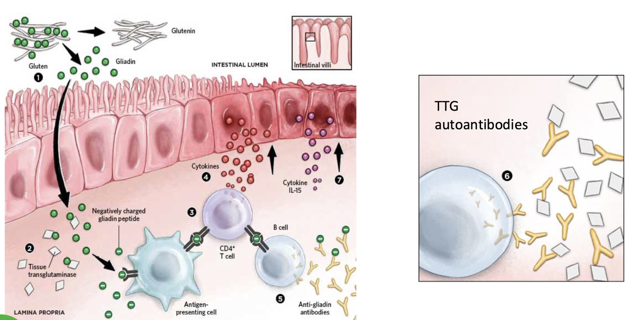 <ol><li><p><strong>Gliadin exposure</strong></p></li><li><p><strong>Deamidation by tissue transglutaminase</strong></p></li><li><p><strong>Activation of antigen-specific T cells i.e. CD4+ </strong><span style="color: green;"><strong>by APC that detect - charged gliadin peptide</strong></span></p></li><li><p><strong>Cytokine release i.e. IL-15</strong></p></li><li><p><strong>Anti-gliadin Ab formation</strong></p></li><li><p><strong>Production of autoantibodies against transglutaminase</strong></p></li><li><p><strong>Intestinal mucosal damage and villous atrophy</strong></p></li></ol><p></p>