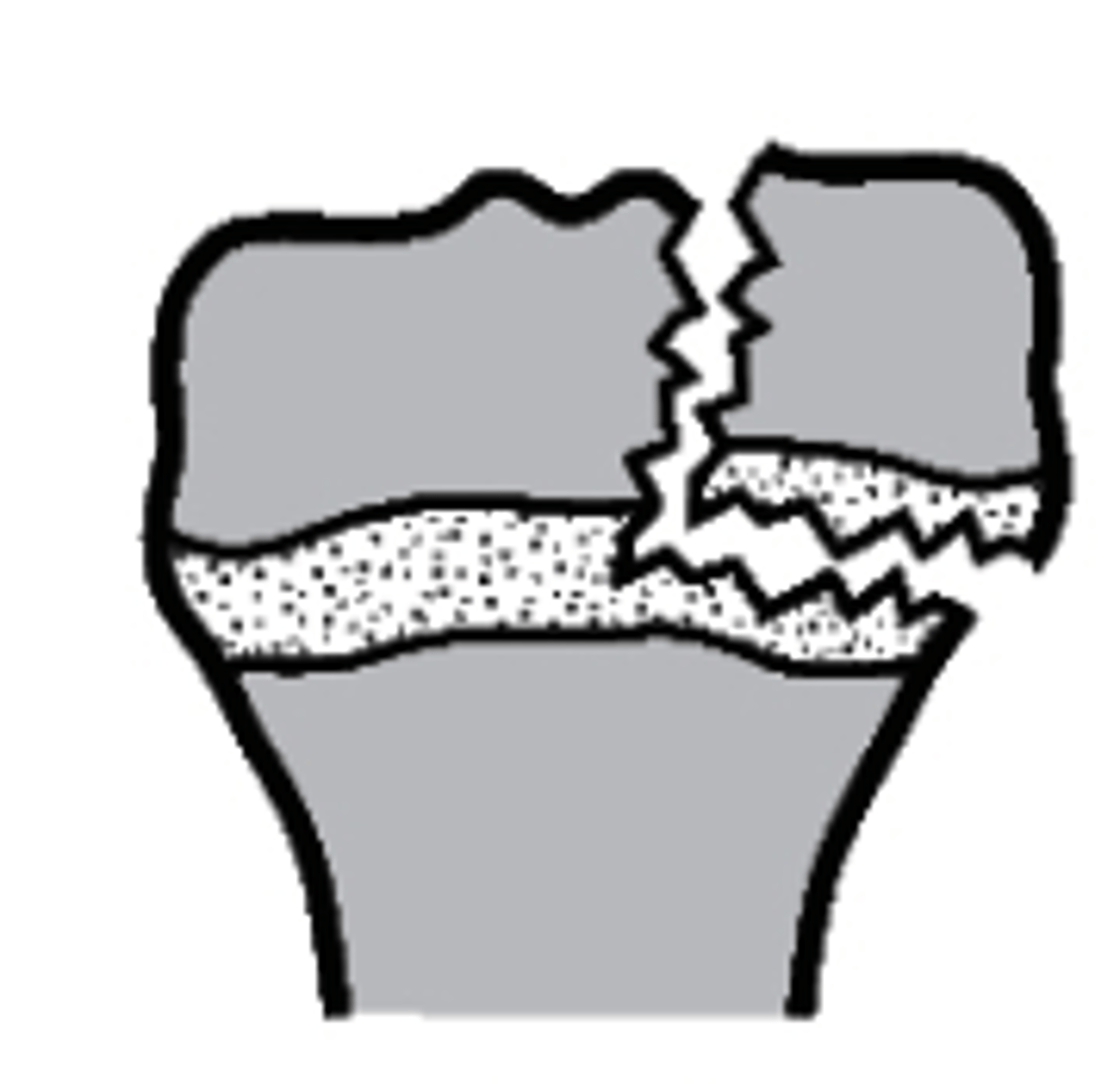 <p>what type of Salter-Harris fracture is this?</p><p>a. Type I</p><p>b. Type III</p><p>c. Type IV</p><p>d. Type II</p>