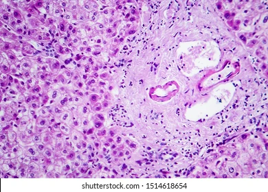 <p>c) Accumulation of water within the cytoplasm due to failure of ion pumps</p>