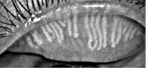 <ul><li><p><strong>thickened</strong> meibomian secretions</p></li></ul><p></p><ul><li><p><strong>microliths</strong> - plaques</p></li></ul><p></p><ul><li><p>meibomianitis - <mark data-color="green" style="background-color: green; color: inherit;">passive retention of secretions</mark> (chalazion, styes)</p></li></ul><p></p><ul><li><p><mark data-color="yellow" style="background-color: yellow; color: inherit;">foam in tear meniscus</mark></p></li></ul><p></p><ul><li><p><strong>unstable tear film</strong> -<u>evaporative tear deficiency</u></p></li><li><p>—> meibomian glands secrete oily lipid layer of tear film so reduced</p></li></ul><p></p>