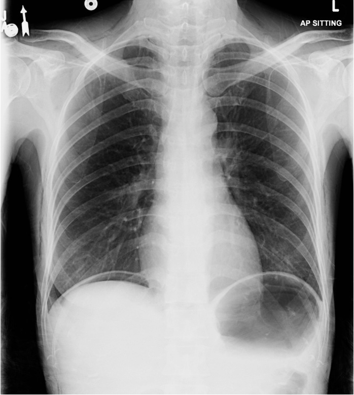 <p>CXR</p>