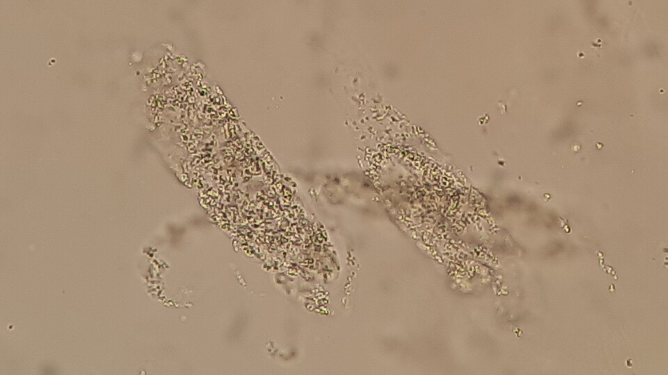 <p>renal disease</p>