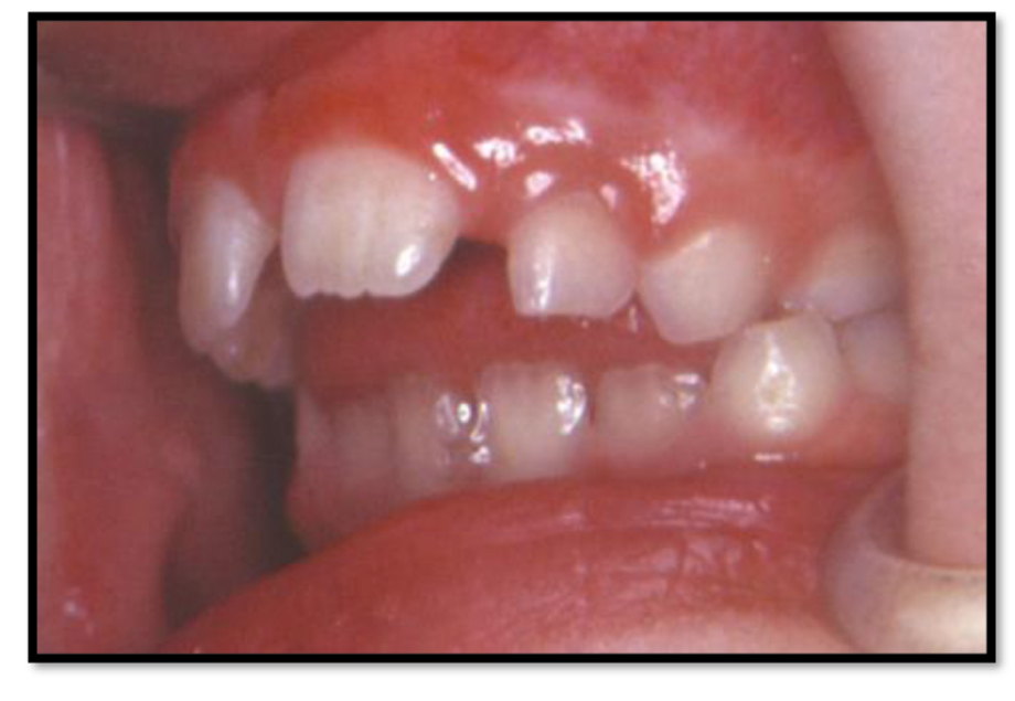 <p>Forward movement of tongue tip between teeth to meet the lower lip during deglutition</p><p>Class 2 div 1</p><p>Maxillary constriction</p><p>General spacing between teeth</p><p><strong>Anterior open bite</strong></p><p>Vs Retroinclination of incisors</p>