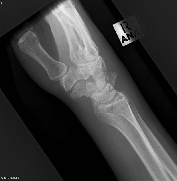 <p>Describe the abnormality demonstrated.</p>