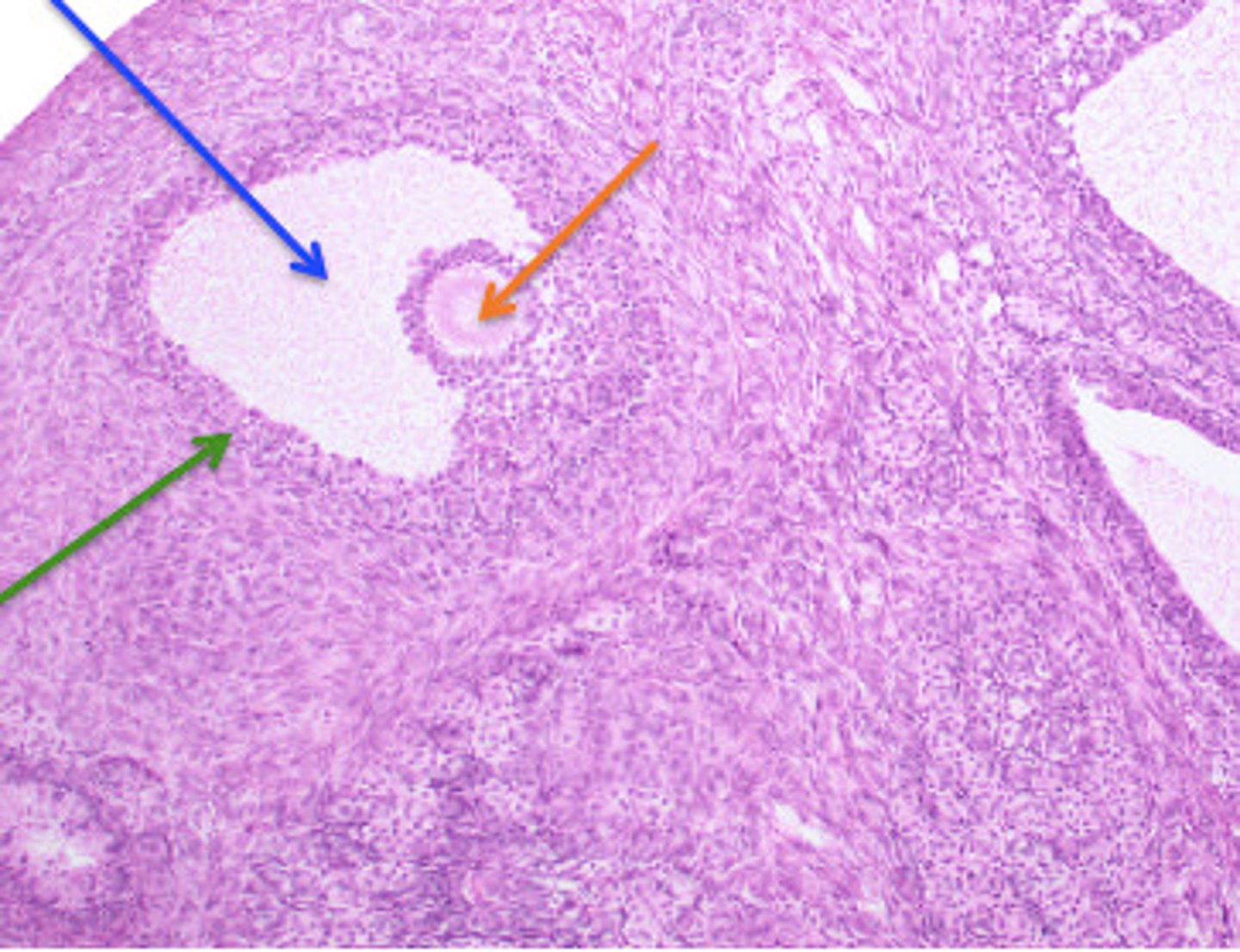 <p>a single substantial cavity formed from the enlargement and coalesce of the secondary follicle</p>