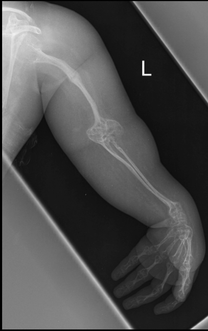 <p>what is seen here for this case of osteogenesis imperfecta?</p>