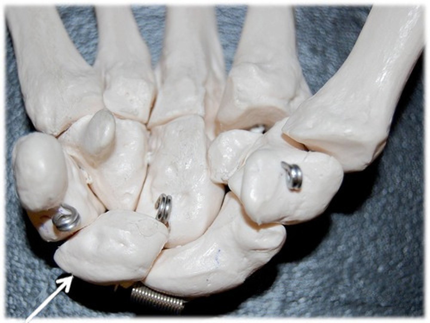 <p>Lunate of carpal</p>