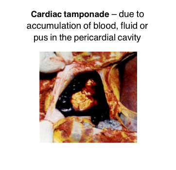 <p>Cardiac Tamponade </p>