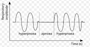 <p><strong>Irregular breathing pattern</strong> with clusters of breaths followed by periods of apnea (pause)</p><p></p><p>Cause: Injury to the medulla oblongata (brain stem) </p><p></p><p>Breathe → breathe → breathe → pause → breathe → breath → breath → pause (repeat)</p>