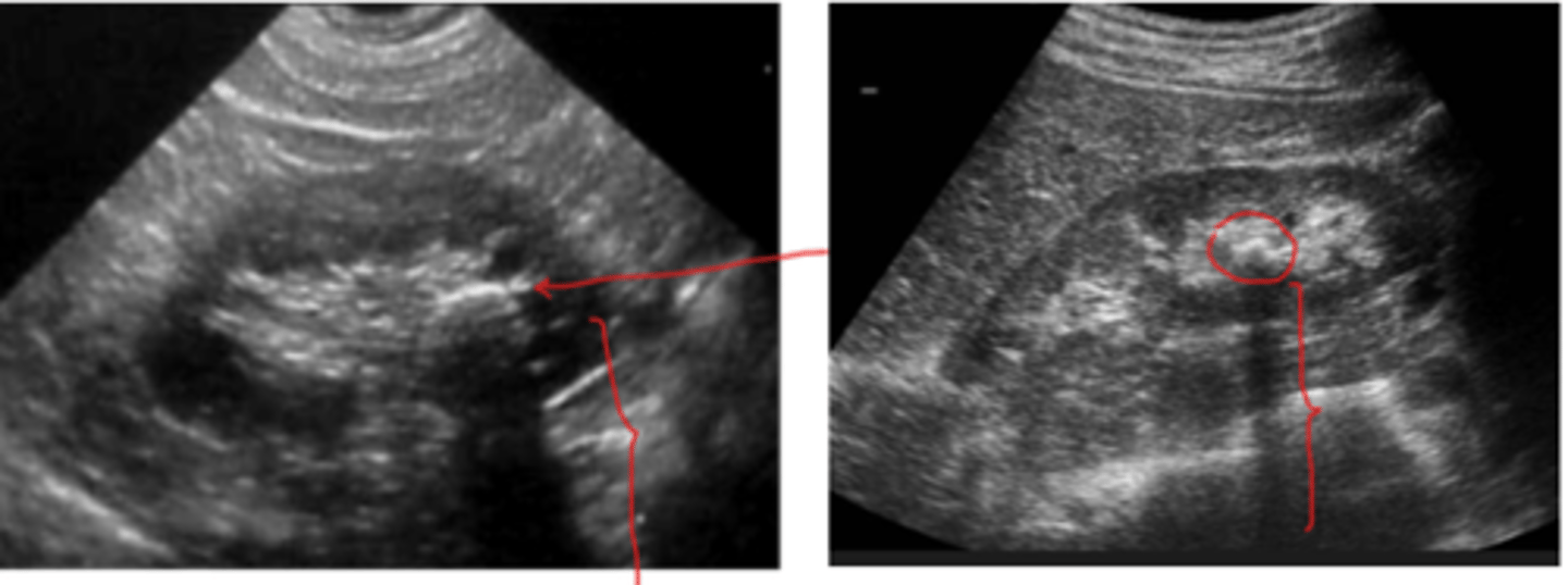 <p>los cálculos pueden estar dentro del parénquima renal en lugar del uréter. Se observan también como zonas hiperecogénicas con sombra acústica.</p>