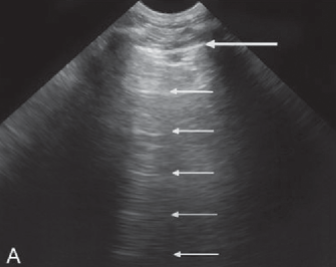 <ul><li><p><span style="background-color: transparent;">Occurs between two strong reflectors</span></p><ul><li><p><span style="background-color: transparent;">Sound waves bounce back and forth between structures</span></p></li></ul></li><li><p><span style="background-color: transparent;">Appears as equally spaced extra reflectors on the image</span></p><ul><li><p><span style="background-color: transparent;">Commonly occurs in the anterior portion of the bladder</span></p></li></ul></li><li><p><span style="background-color: transparent;">Reduced with harmonics (but can’t be completely eliminated)</span></p></li></ul><p></p>