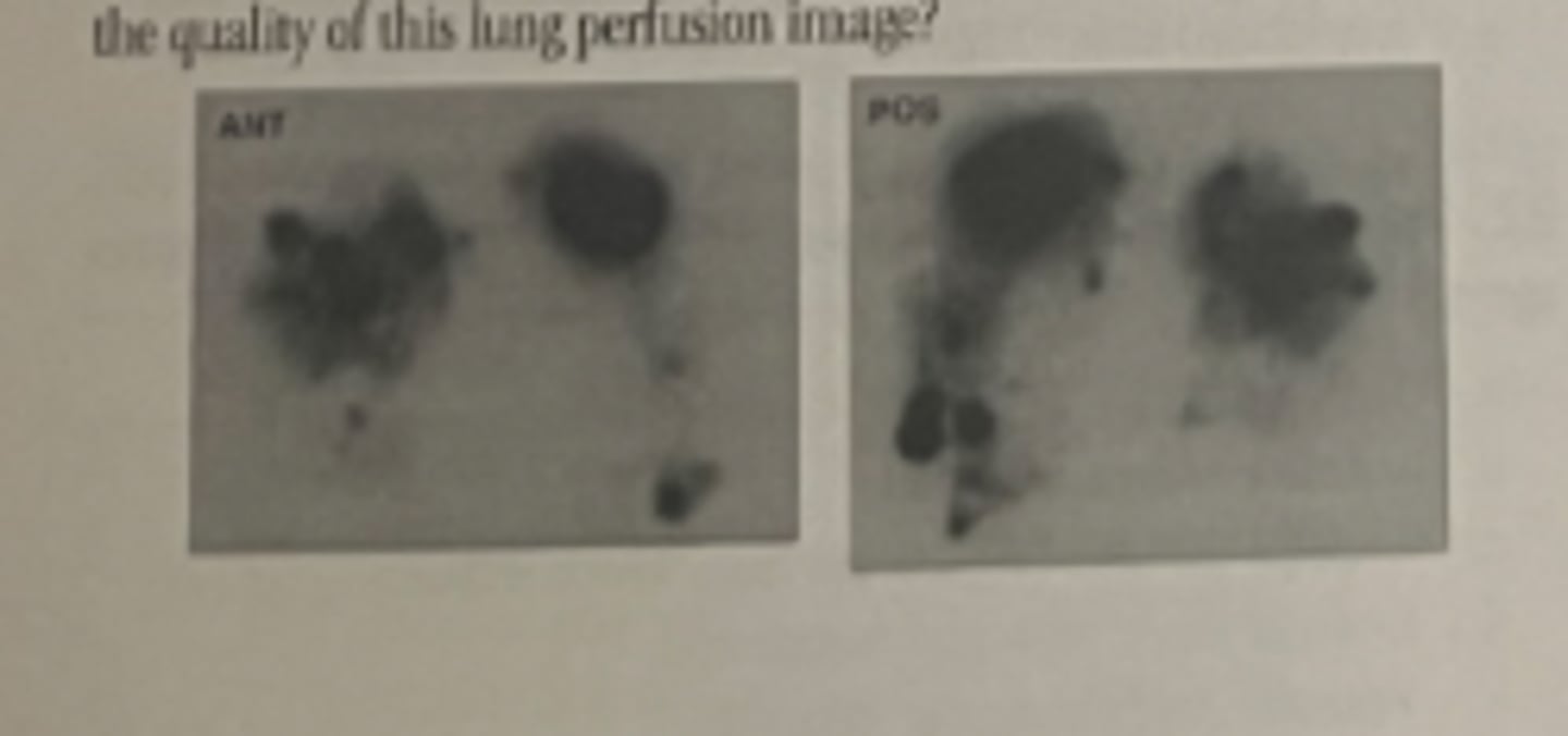 <p>c. Blood clotted to MAA particles was injected intravenously</p>
