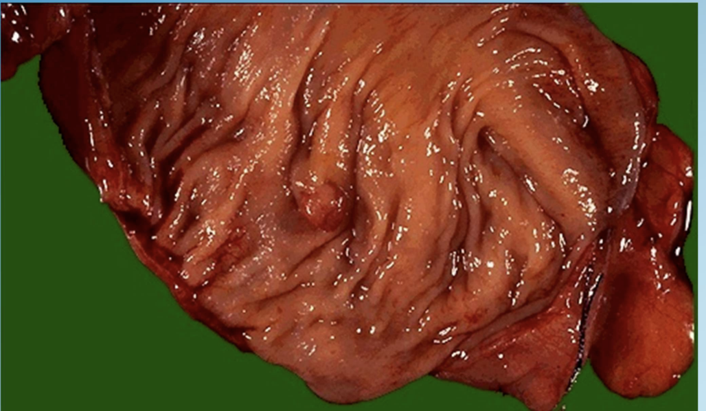 <p>Hyperplastic Polyp</p>