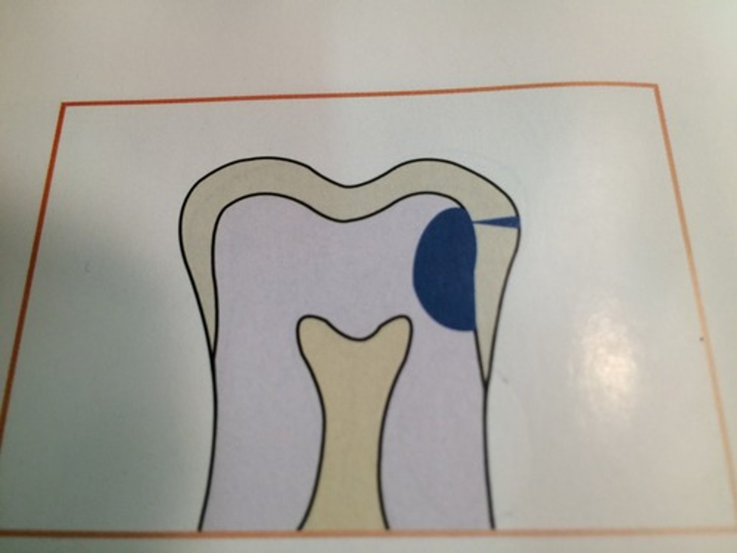 <p>extends through enamel and dentin more than half distance towards the pulp</p>