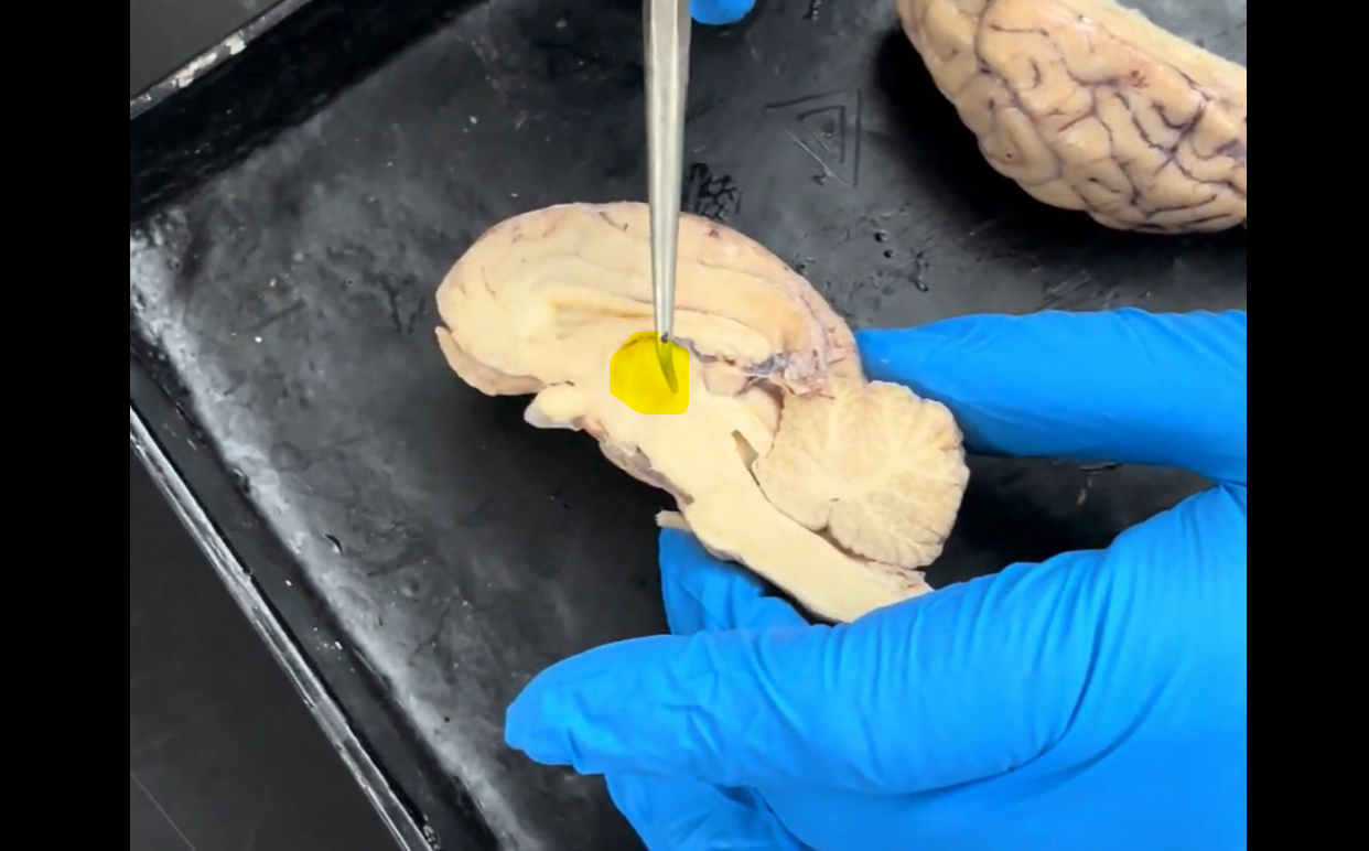 <p>Name the part of the brain highlighted in yellow that the probe is pointing to.</p>