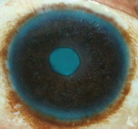 <ul><li><p>common in heavily pigmented races</p></li><li><p>produce pigmented ring at limbus</p></li><li><p>protect stem cells at limbus from UV damage</p></li><li><p>patches on bulbar conj</p></li></ul><p></p>
