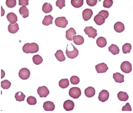 <p>Forma</p><p><strong>Poiquilocitosis:</strong></p>