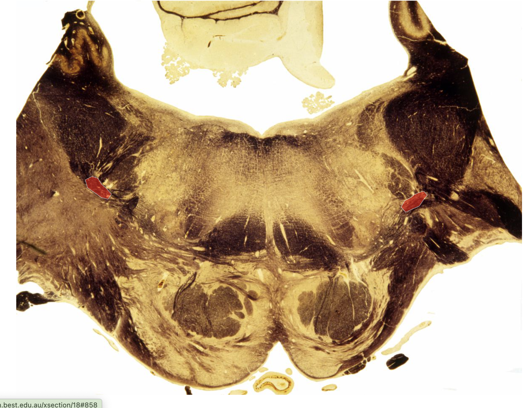 <p>Ventral Spinocerebellar Tract</p><p></p><p>Same location —&gt; just superior to spinothalamic, Middle Pedouncle makes the difference bc zoomed out </p>