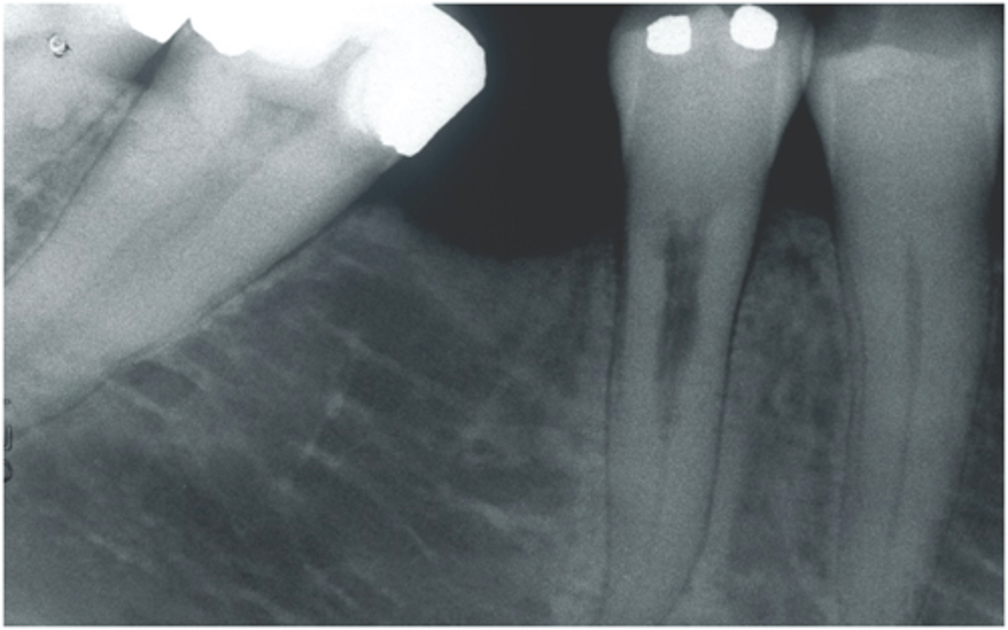 <p>ID the indication for endo surgery:</p><p>(Communicated externally on the DB surface)</p>