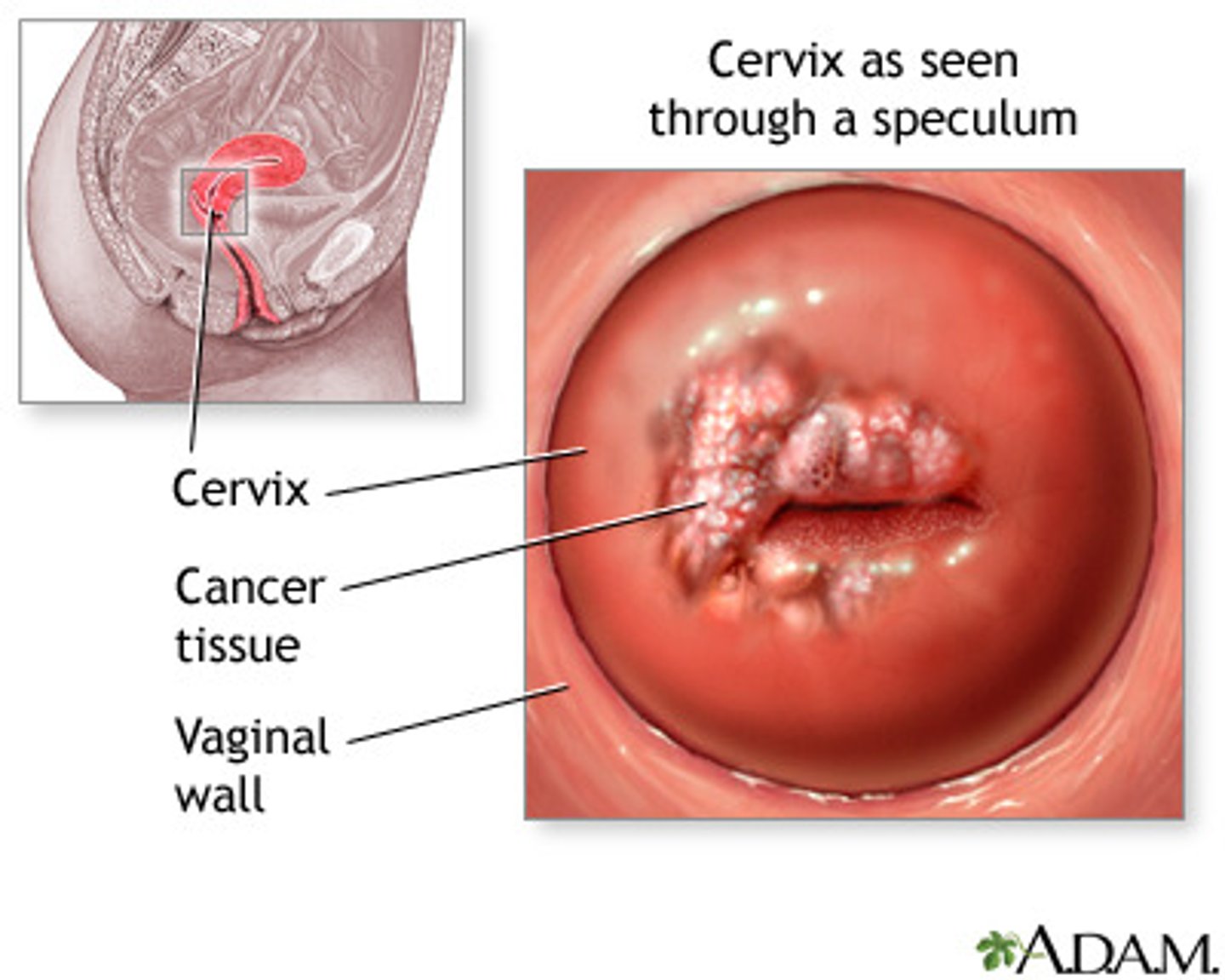 <p> cell growth in the cervix; can be caused by Human Papilloma Virus and Herpes Simplex Virus</p>