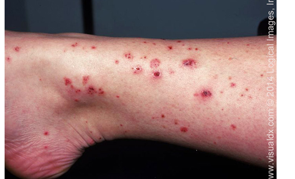 <p>acute IgA mediated vasculitis involving small vessels of skin, GI tract, kidneys, joints, and rarely lungs and CNS</p>