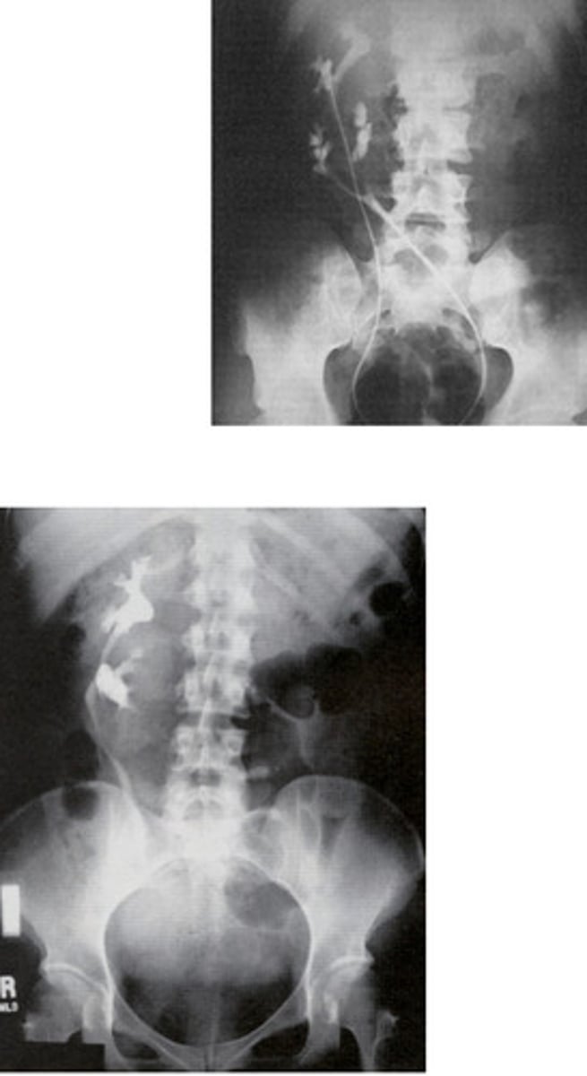 <p>What congenital anomaly occurs when one kidney is located on the wrong side but facing the correct direction?</p>